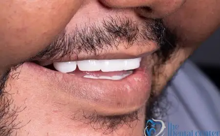 زراعة الأسنان زراعة الأسنان